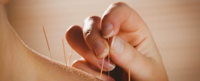 Come curare il mal di testa con l’agopuntura